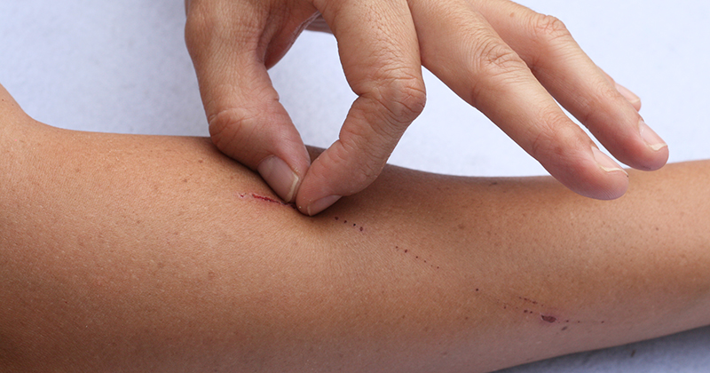scab