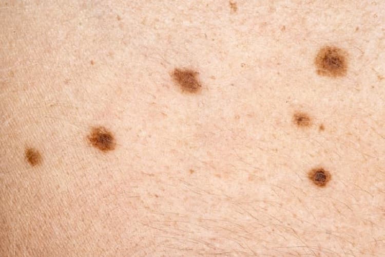 skin-moles-250px